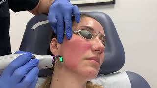 VBeam Perfecta pulse dye laser treatment for facial redness and rosacea by Dr Shaun Patel [upl. by Yolane364]