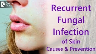 Why do i get recurrent fungal skin infections  Dr Amee Daxini [upl. by Bev]