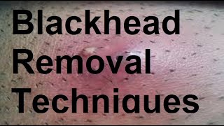 blackhead removal techniques [upl. by Hilel]