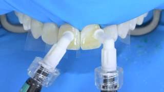 Fluorosis treatment using Icon infiltration step by step [upl. by Allix]