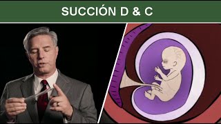 Aborto Quirúrgico durante el Primer Trimestre Succión D amp C Dilatación y Curetaje [upl. by Nonnahsed]