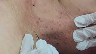 Warts and Syringoma Removal [upl. by Lavinia]