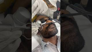 Laser treatment for Dark spots removal [upl. by Llennehc]