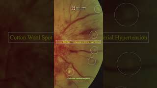 Retinopathy in Malignant Hypertension [upl. by Aistek]