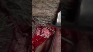 Maxillary Sinus Lift with Lateral Window Technique simultaneously with Lateral Ridge Augmentation [upl. by Sesilu977]