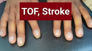 Tetralogy of Fallot Stroke Nail Clubbing [upl. by Bibeau]