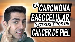 CARCINOMA BASOCELULAR  Experiencia y otros tipos de cáncer de piel células escamosas y melanoma [upl. by Elnore]