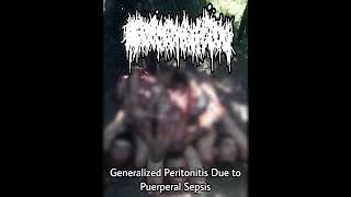 FERMENTATION  GENERALIZED PERITONITIS DUE TO PUERPERAL SEPSIS SINGLE 2022 [upl. by Maure]