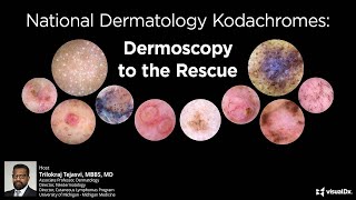 National Dermatology Kodachromes Dermoscopy to the Rescue [upl. by Yziar]