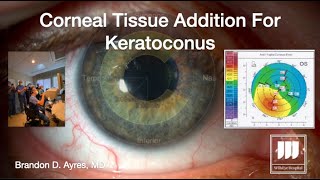 Corneal Tissue Addition For Keratoconus CTAK [upl. by Basso570]