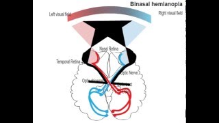 binasal hemianopia [upl. by Litman]