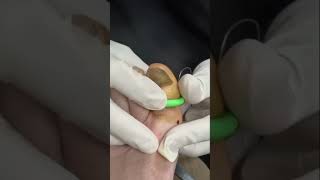 How to treat Toenail Fungus🤯 [upl. by Naraj]