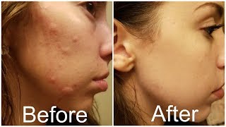 How I Got Rid Of My Hormonal Acne FOREVER [upl. by Mat]