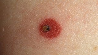 How to Spot Lyme Disease  WebMD [upl. by Yaffit140]