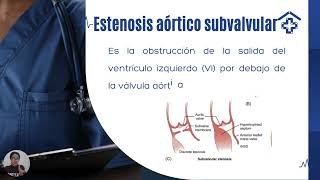 Estenosis aóticaecocardiografía [upl. by Ez]