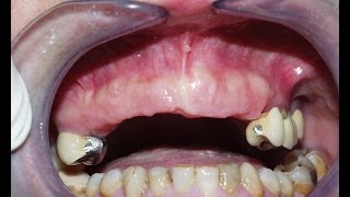 Implantes Dentales T5 [upl. by Araic]