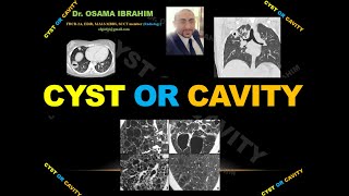 Cyst or Cavity [upl. by Fruma]