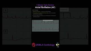 Atrial fibrillation Pathophysiology and ECG medical ukmla cardiology atrialfibrillation [upl. by Iredale]