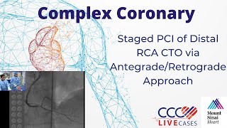 Staged PCI of Distal RCA CTO via AntegradeRetrograde Approach  September 16 2014 Webcast [upl. by Atnuahc443]