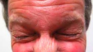 What is Blepharospasm Symptoms Causes Treatment [upl. by Halona45]