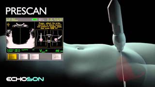 Pinit Bladder Volume Scanner  exams principle YT [upl. by Lertsek502]