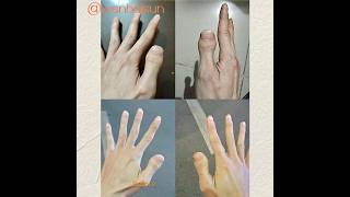 Brachydactyly type D toethumbs clubbed thumbs stubby thumbs thumbnail brachydactyly thumb [upl. by Alicul15]