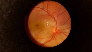 Choroidal Metastasis with Exudative Retinal Detachment [upl. by Navonod305]