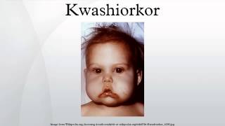 Kwashiorkor [upl. by Ilrahc]