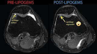 Ultrasoundguided Regenerative Medicine cartilage regrowth  knee osteoarthritis treatment [upl. by Eeram10]