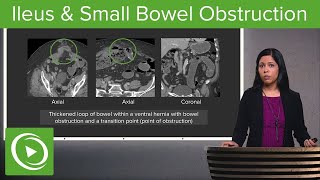 Bowel Obstruction and Ileus Ileus amp Small Bowel Obstruction – Radiology  Lecturio [upl. by Viki121]