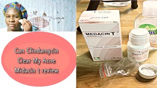 Can Clindamycin Clear My Acne  Midacin T Topical Solution  Review amp How To Use acne midacinT [upl. by Ysset782]