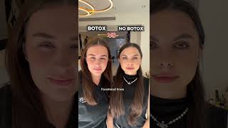 BOTOX VS NO BOTOX antiaging botulinumtoxin [upl. by Letniuq674]