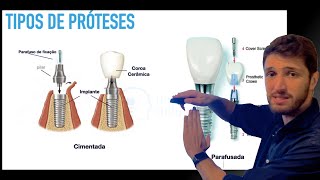 Tipos de prótese em Implantodontia  Cimentadas Parafusadas Unitárias ou Múltiplas [upl. by Lowery]