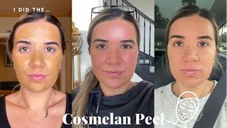 The Cosmelan Peel II My 1st Chemical Peel in Over TWO Years [upl. by Petua913]