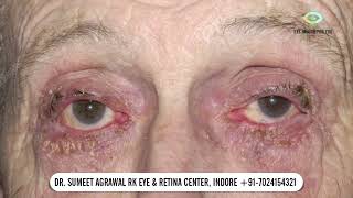 जानिये EYE DROPS के SIDE EFFECTS और ALLERGIES [upl. by Andreas]