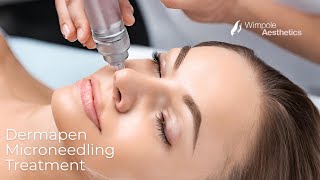 Dermapen Micro Needling Treatment of Acne Scars Animation by Needlelogic coms [upl. by Lauren]