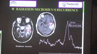 TMT NeuroRadiology MR Spectroscopy [upl. by Sadnalor]