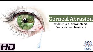 Corneal Abrasion A Closer Look [upl. by Esidarap]