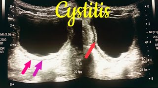 Cystitis kya hota hai  cystitis in children  cystitis symptoms  cystitis ultrasound [upl. by Notlim]