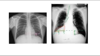 🔴 PNEUMONIE PLEURESIE INFARCTUS OU ATELECTASIE [upl. by Enilkcaj]