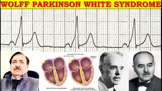 Arrhythmias associated with Wolff Parkinson White Syndrome  Lectures by Dr Alamzeb [upl. by Jain]