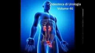 Cisti dellepididimo Video di Urologia e Andrologia  wwwurologiaandrologianet [upl. by Cordie132]