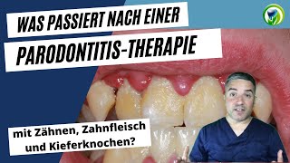 Was passiert mit Zähnen Zahnfleisch und Kieferknochen bei einer Parodontitistherapie [upl. by Ahsart894]