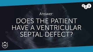 60 Seconds of Echo Teaching Answer Ventricular Septal Defect [upl. by Jary]