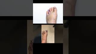 Broken Toe Fractured Toe Symptoms and Causes  Diagnosis  Treatment  Prevention healthcare [upl. by Ettenirt]