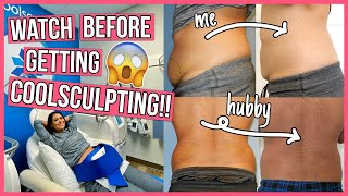 SHOCKING Coolsculpting Before amp After 6 Things You NEED to Know [upl. by Quitt984]