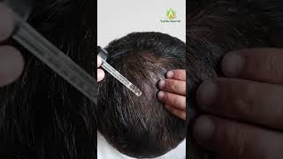 Hair fall treatment in Ayurveda [upl. by Fessuoy]