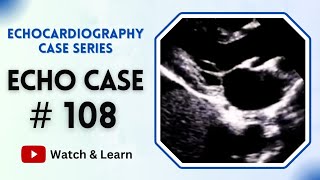 ECHO CASE 108  Echocardiography For Beginners [upl. by Avlasor]