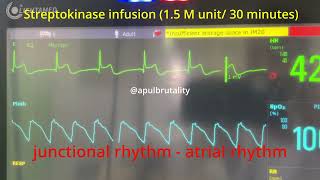 Anterior STEMI fibrinolysis  thrombolysis using Streptokinase Fibrion [upl. by Horwath980]