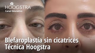 Blefaroplastía sin cicatrices  Técnica Hoogstra  23236 [upl. by Atalanti]